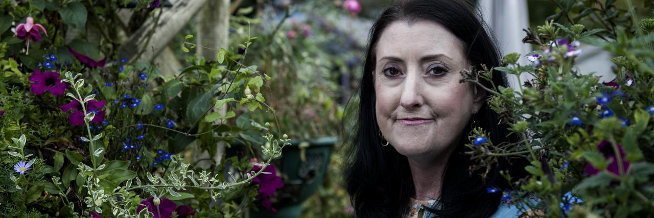 Patientin mit Sklerodermie